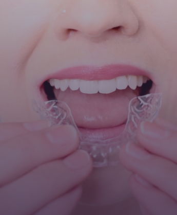 Aparatele Dentare Aliniate